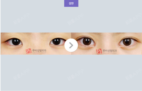 微微一调很倾城,开眼角手术会有风险吗?每个人