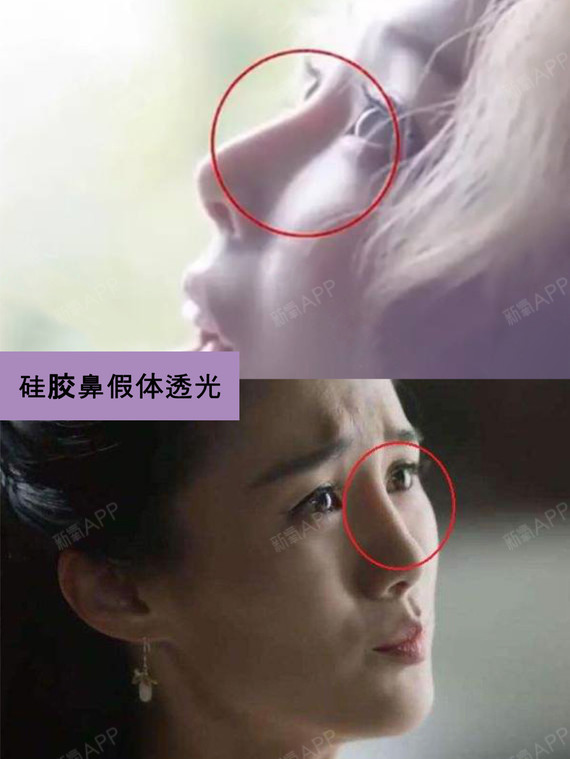 史上最全隆鼻假体材料信息汇总,小白看完秒变达人!