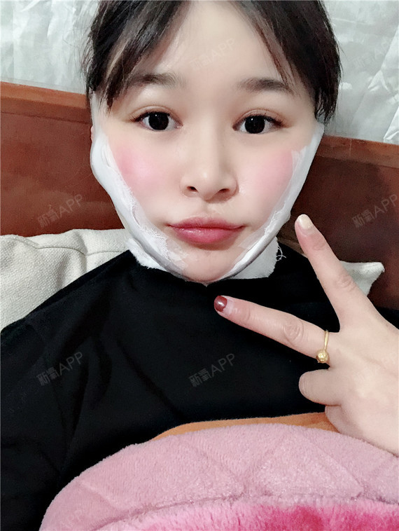 杭州面部吸脂好不好_效果图_小溪流水1面部吸脂术后第0天_新氧美容