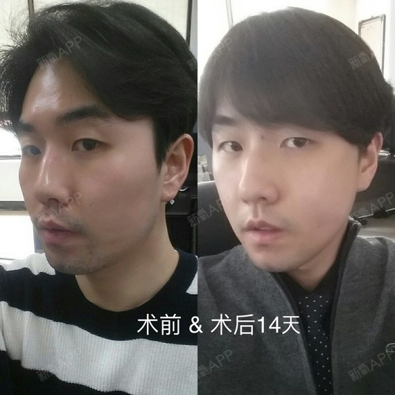 术前术后恢复照片 都是我院的真实案例 欢迎感兴趣的朋友们 私信我哦