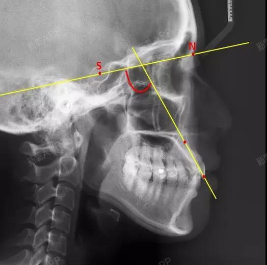 3,u1-sn      反映上中切牙(俗称门牙)相对于颅底的倾斜度,角度越