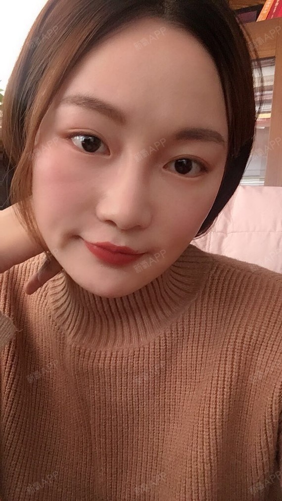北京玻尿酸丰鼻基底好不好_效果图_花想容呢玻尿酸丰鼻基底术后第1天
