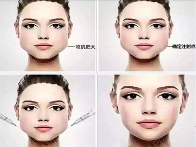 这几年由于注射美容越来越受欢迎,很多人对注射瘦脸已经比较熟悉了,也