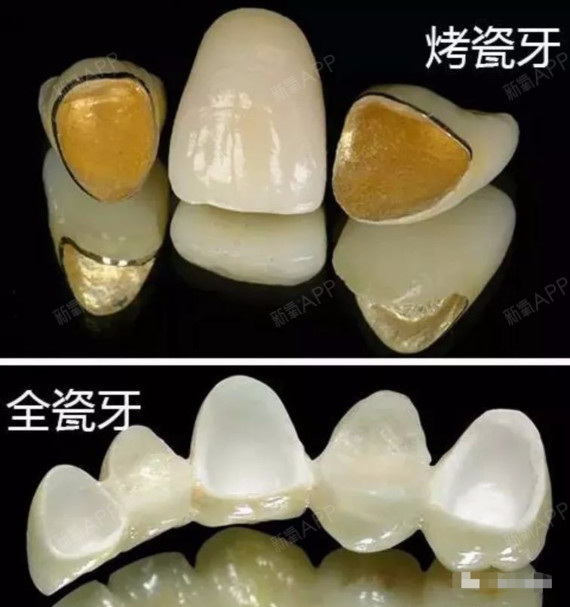 根管治疗后戴个牙冠