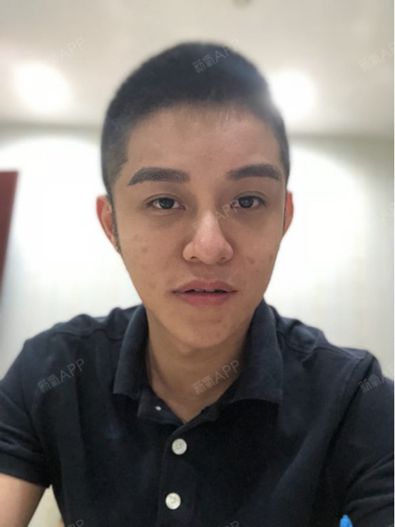 就做小鲜肉 ▼ 年轻轻轻却因为法令纹,面颊凹陷, 苹果肌扁平,额头不