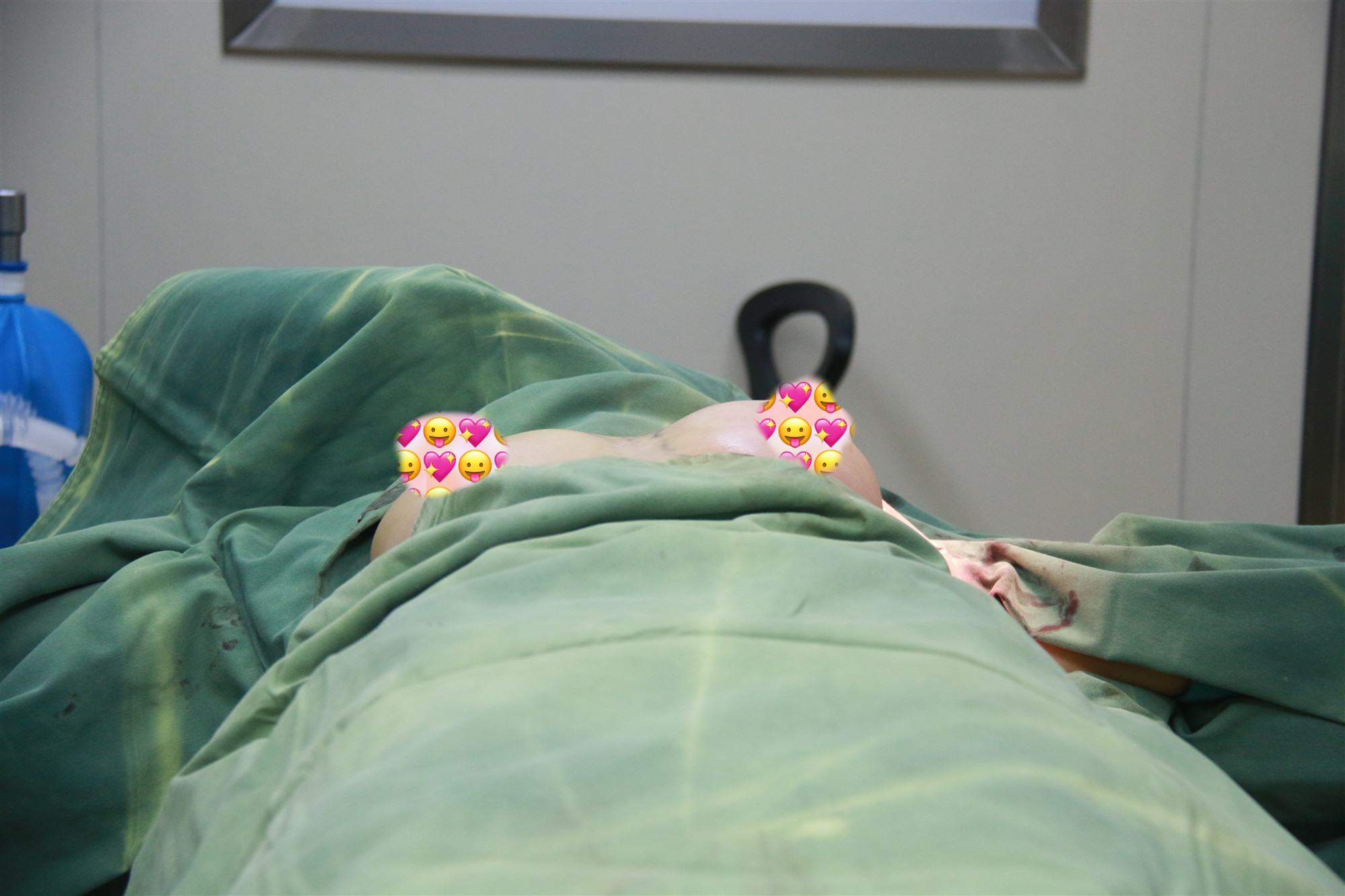 假体隆胸第1天