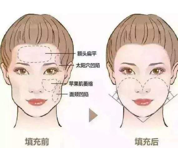 你到底是脸瘦了,还是面部凹陷了呢?