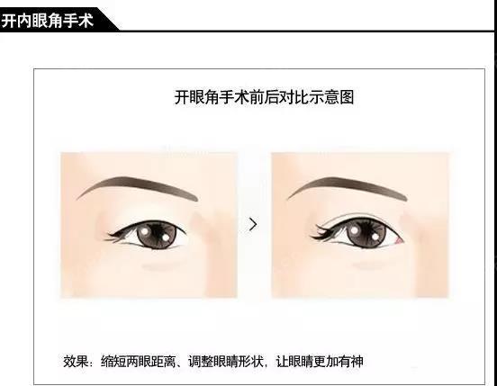 先天性小眼症由于既有睑裂狭小,严重的内眦赘皮,又常合并内眦间
