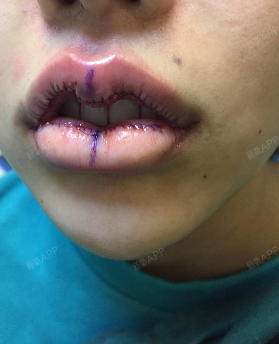 自己的唇综合手术图片唇综合手术割屁股嘴巴割破割嘴唇图片割嘴唇割手