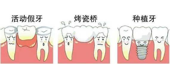 搞清楚缺牙修复的那些事儿目前市面上的缺牙修
