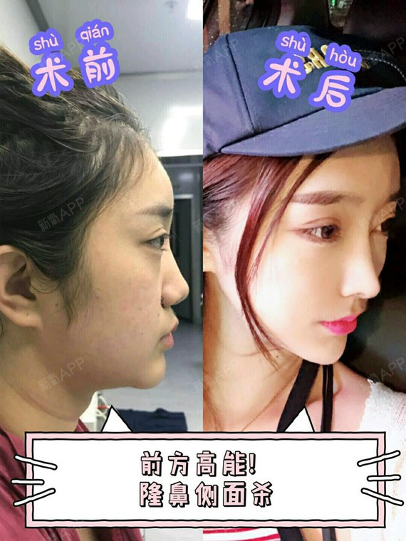 肋软骨隆鼻