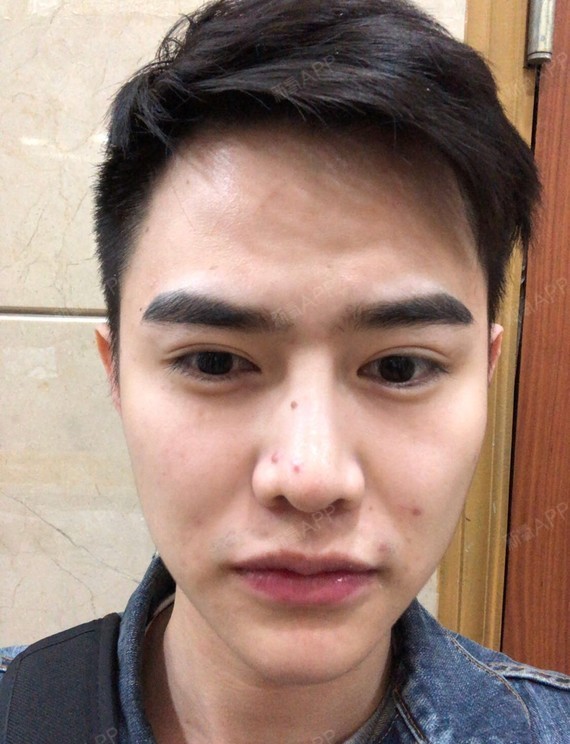 m唇手术