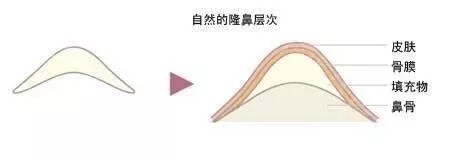 鼻综合术后显假是为什么?