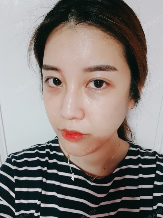 小脸静静颧骨颧弓整形术第56天美丽日记-新氧