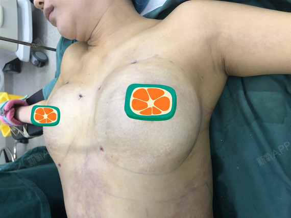 我爱睡觉乳房下垂矫正第0天美丽日记-新氧美容