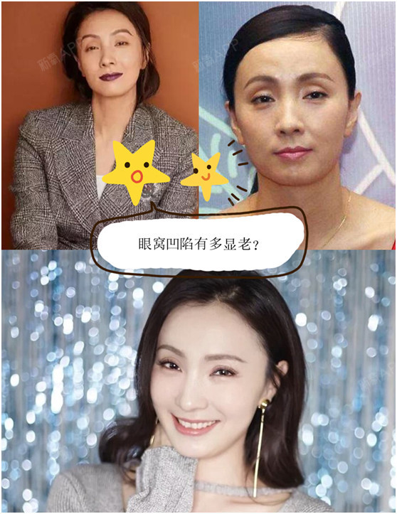 眼窝凹陷会显老?[:32]眼窝会显老?那_圈子-新氧美容