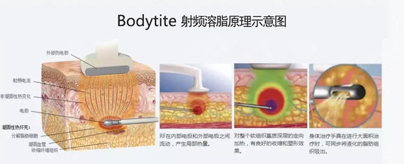 【bodytite射频溶脂】吸不平?瘦后松?全面解决瘦不美!