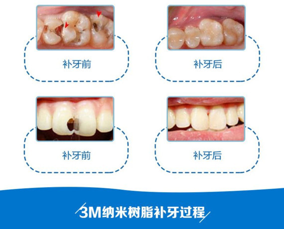 补牙保险 牙齿补牙医保