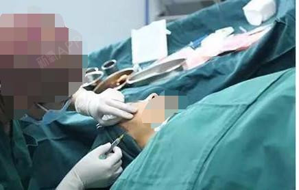 透彻解析脸部埋线提升过程图片、脸部埋线是怎