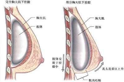 假体丰胸:通过手术将适合患者胸廓类型的假体材料放置在胸部,以达到