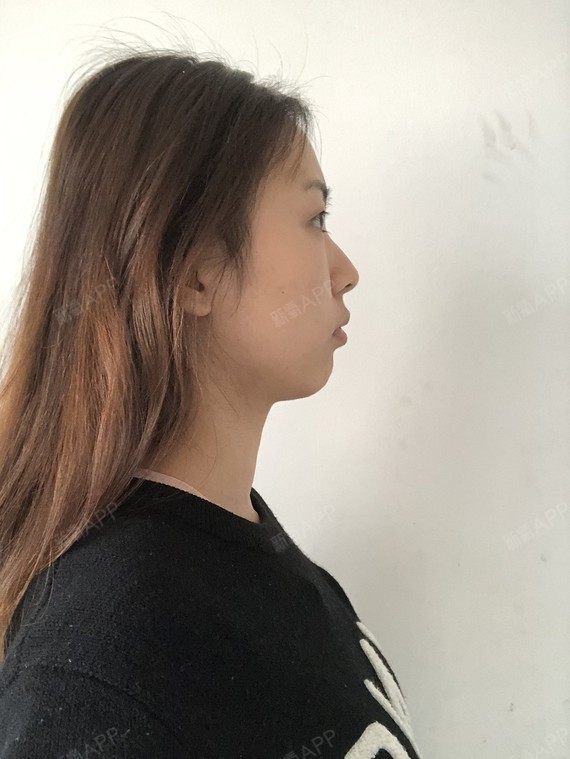 精髓的丽日谢谢用什么表情图片大全切开1双眼皮第0天美表情记-新氧美图片