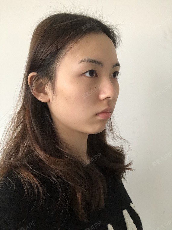 精髓的丽日表情包动态人民币图片切开1双眼皮第0天美表情记-新氧美图片
