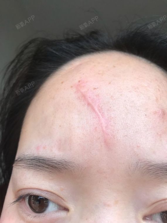 点阵激光