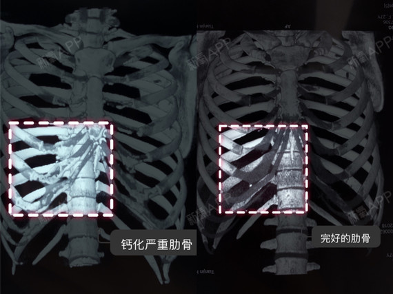 肋骨鼻隆鼻,一生只能取一次肋软骨吗