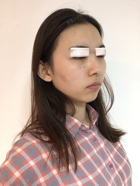 精髓的丽日动态骰子图微信表情包下载切开1双眼皮第2天美表情记-新氧美图片