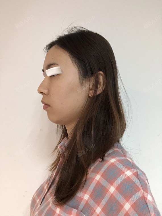精髓的丽日动画表情包了哪里图片去切开1双眼皮第2天美表情记-新氧美图片