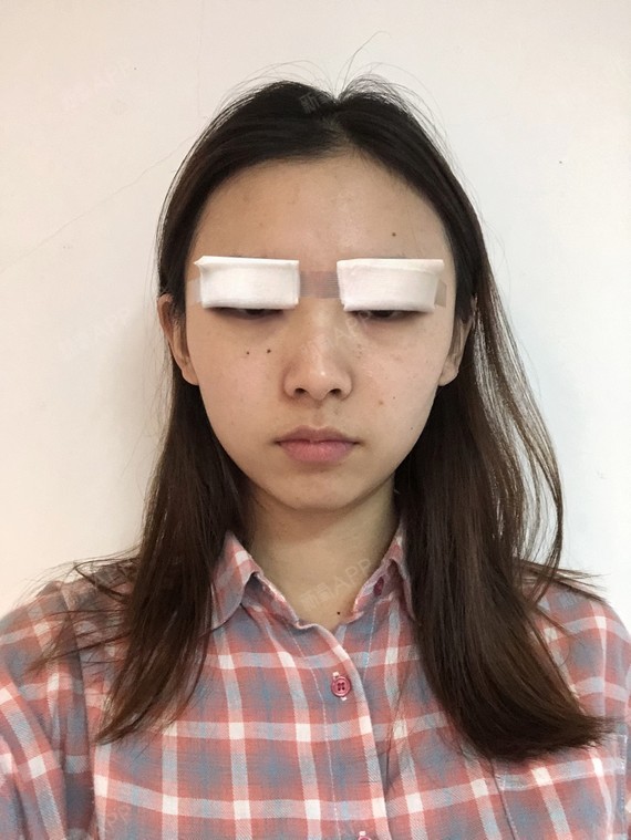 精髓的丽日王琳凯搞笑表情包切开1双眼皮第2天美表情记-新氧美图片