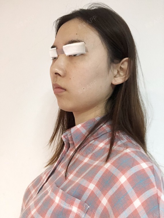 精髓的丽日图片糸乃表情包四切开1双眼皮第2天美表情记-新氧美图片