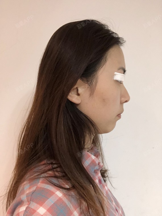 精髓的丽日有事床上说表情图片切开1双眼皮第2天美表情记-新氧美图片