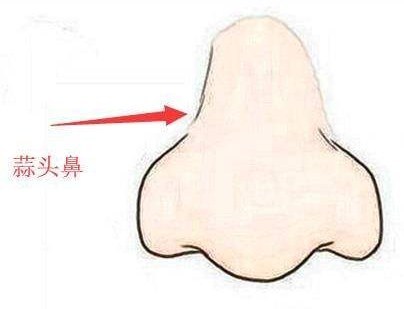 肉鼻头,人们俗称的蒜头鼻,其实就是鼻头和鼻翼肥大,所以整个鼻头看