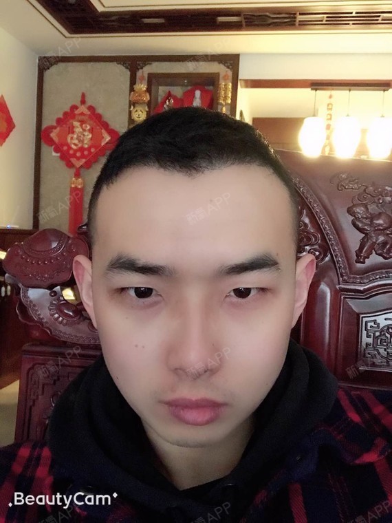 种植鬓角术后7个多月了,还差几个月就满一年了.头发