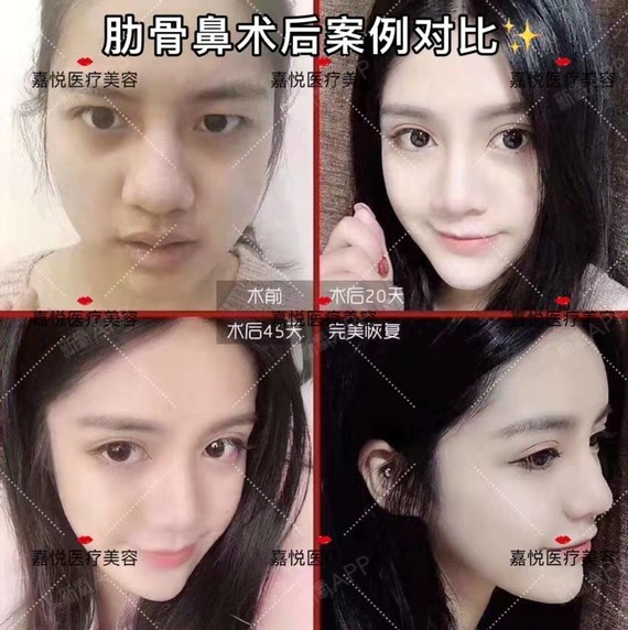 肋软骨隆鼻:让你拥有完美气质