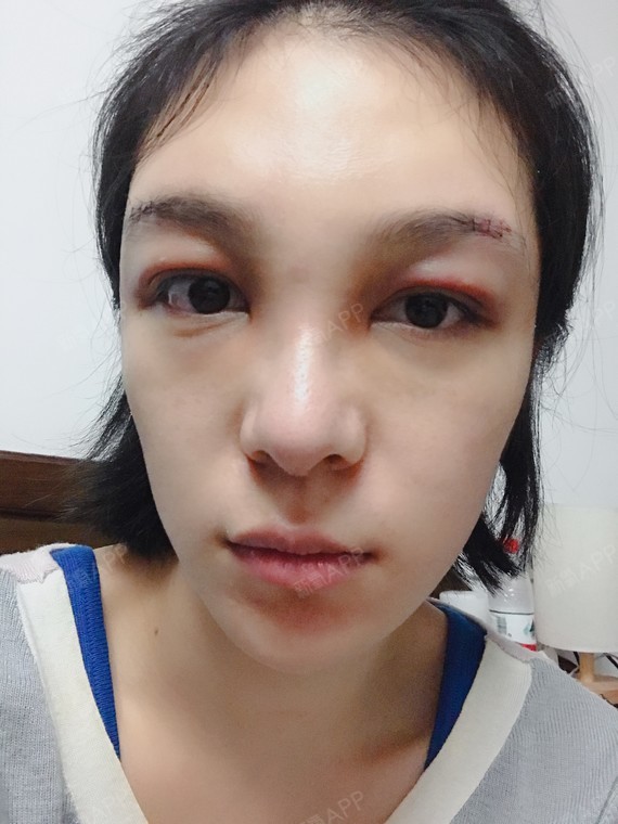 哈喽宝宝们我来跟你们分享了哦已经做完眉弓第三天了