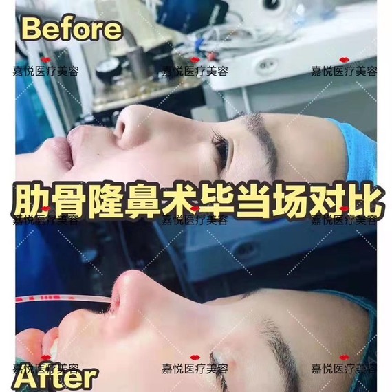 肋软骨隆鼻,塑造稳定,美观的鼻尖