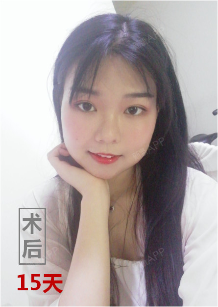 下颌角整形让皮肤下垂松弛?现在流行小V女生纹脖颈图片