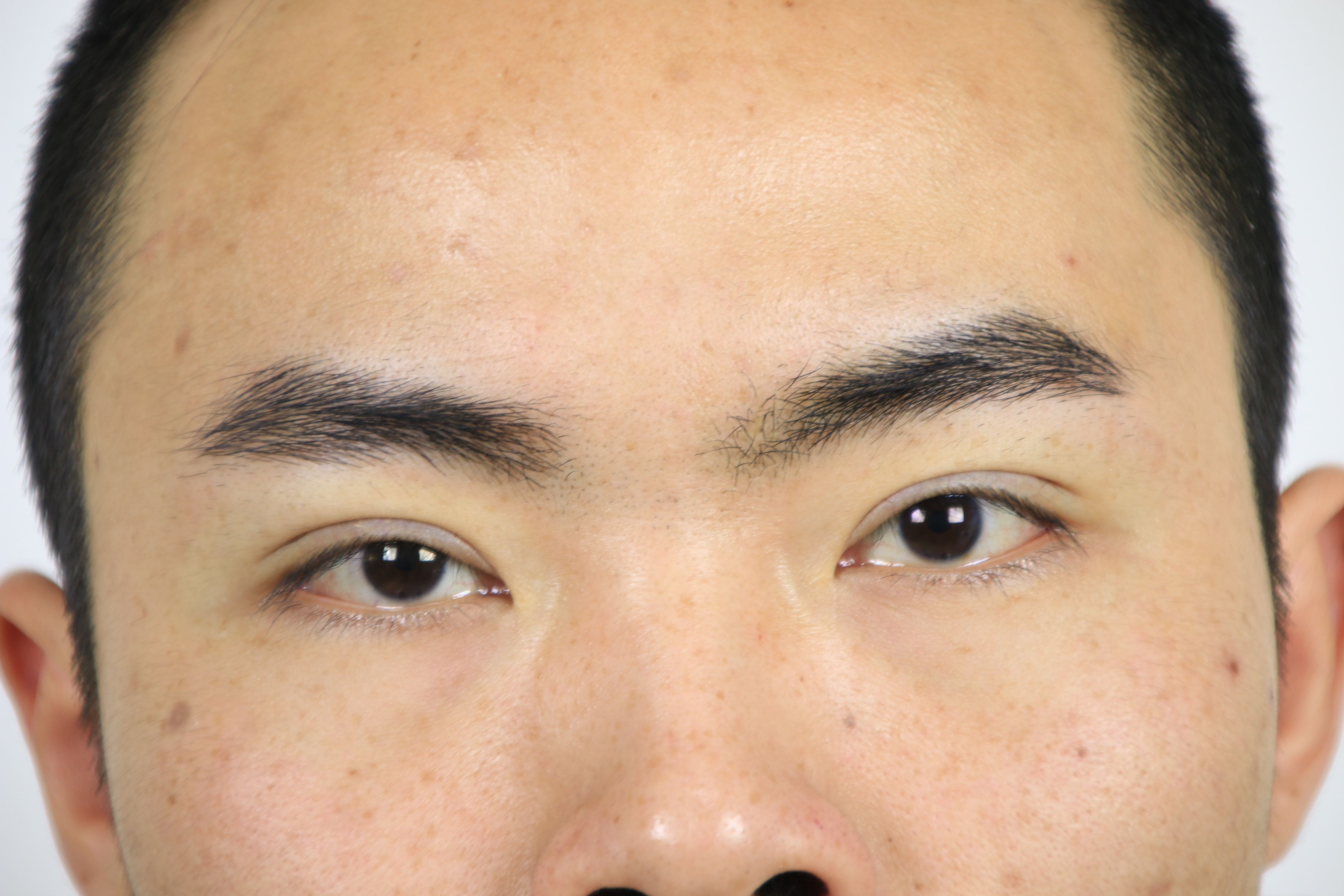 男孩子~术前可以看出来给人的第一眼感觉呆滞无神,眼睛睁不开像没睡醒