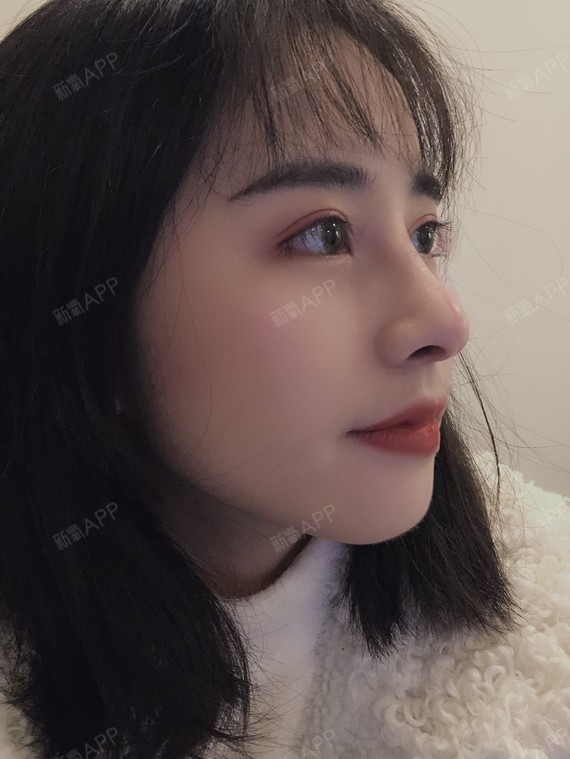 鼻头鼻翼大怎么办?