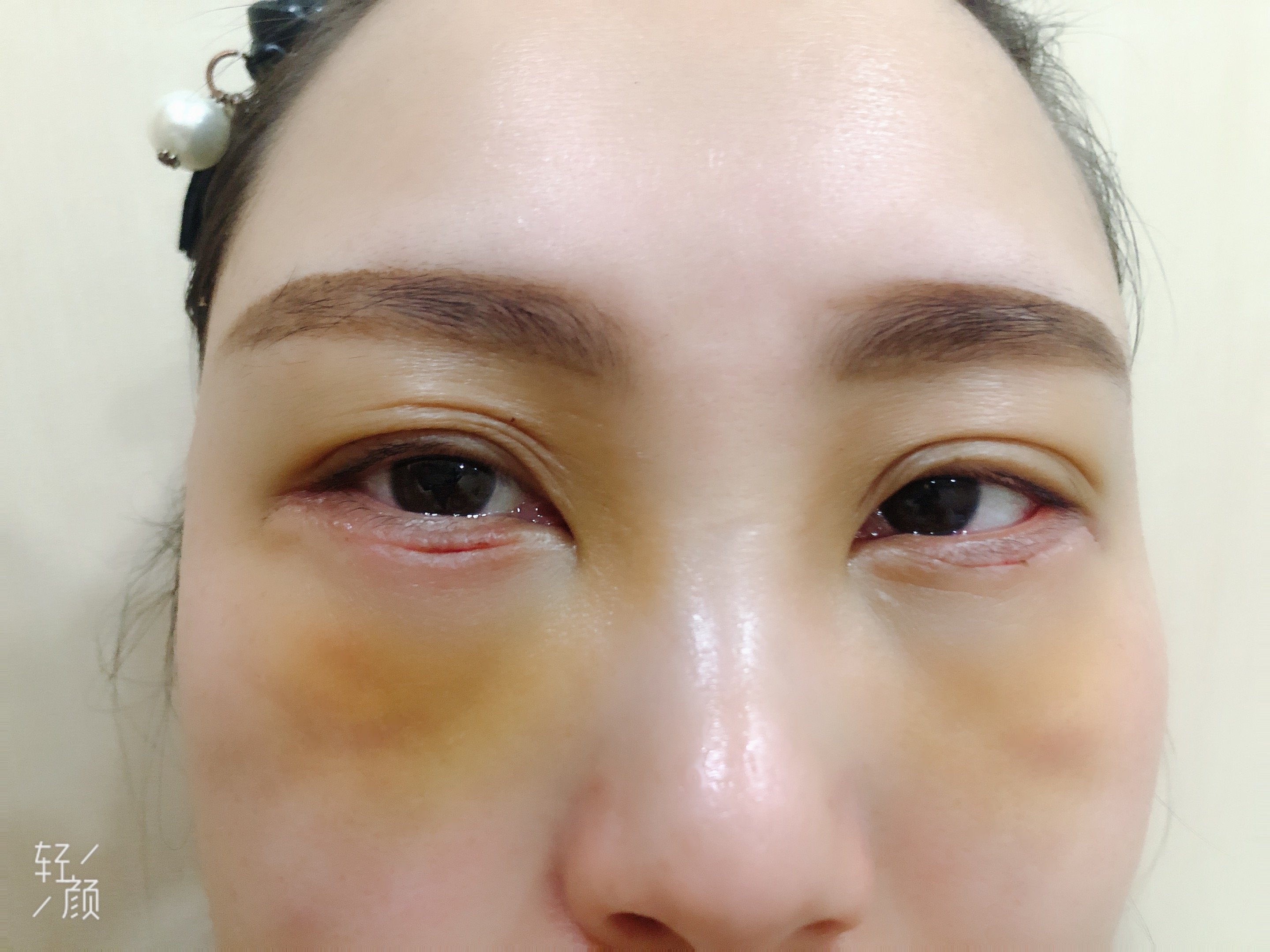 外切去眼袋第6天