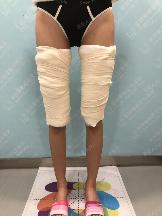 蓝宝宝吸脂瘦大腿第0天美丽日记