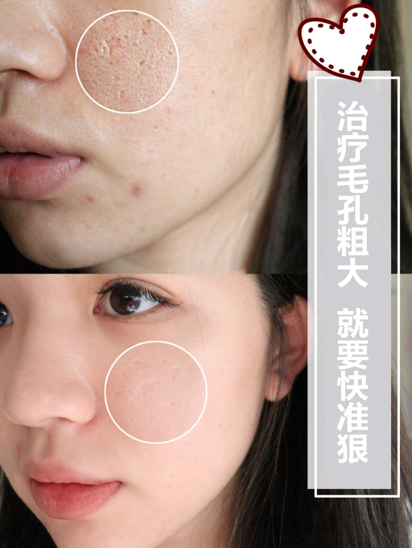 医美解决毛孔粗大选哪种?深度分析看这一篇就够了