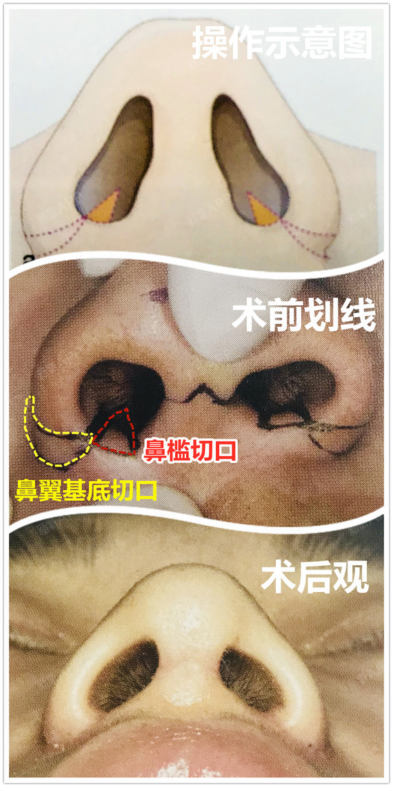 切口有鼻槛缝合延伸至鼻翼基底,以防止术后鼻翼回缩