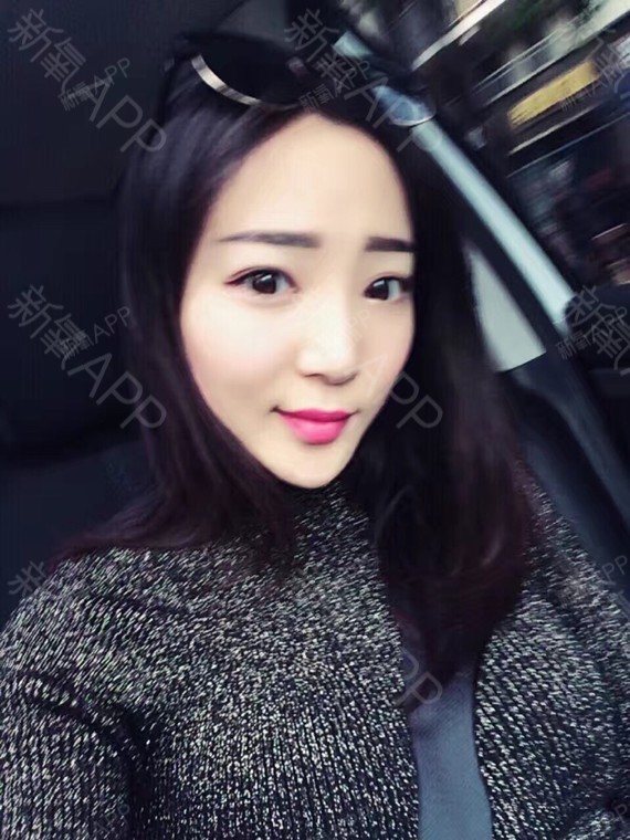 氧气yy99s玻尿酸全脸填充第48天美丽日记-新氧