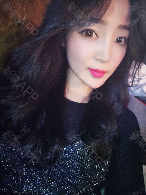 氧气yy99s玻尿酸全脸填充第48天美丽日记-新氧