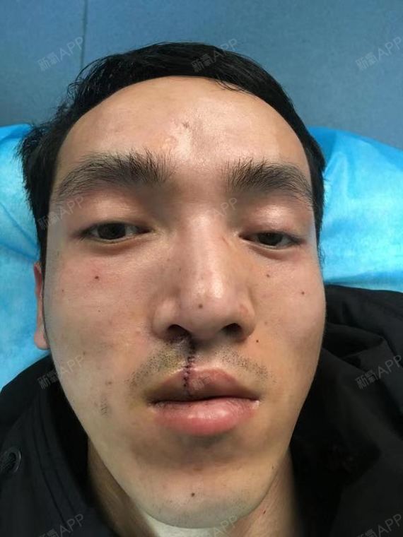 手术祛疤好不好_效果图_奋斗8少年手术祛疤术后第0天
