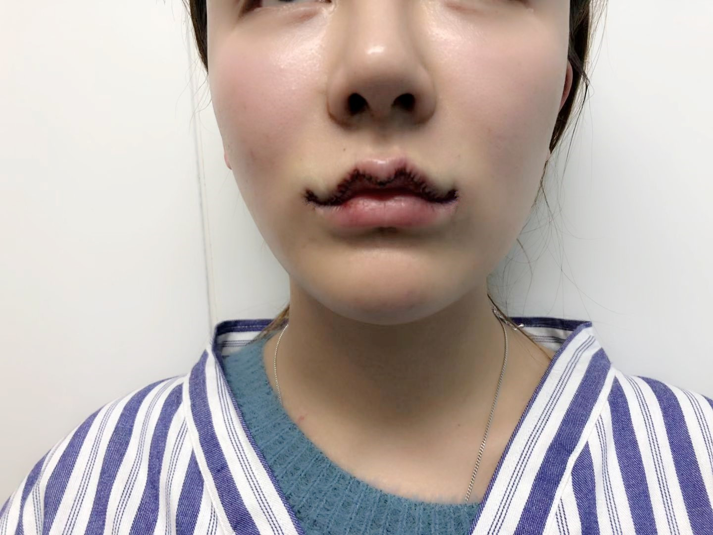 m唇手术第1天