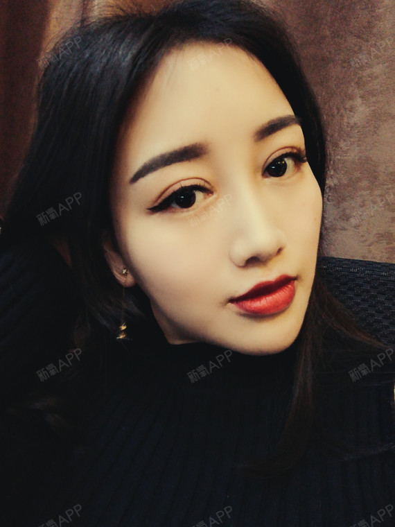 黎明前割个双眼皮切开双眼皮第131天美丽日记